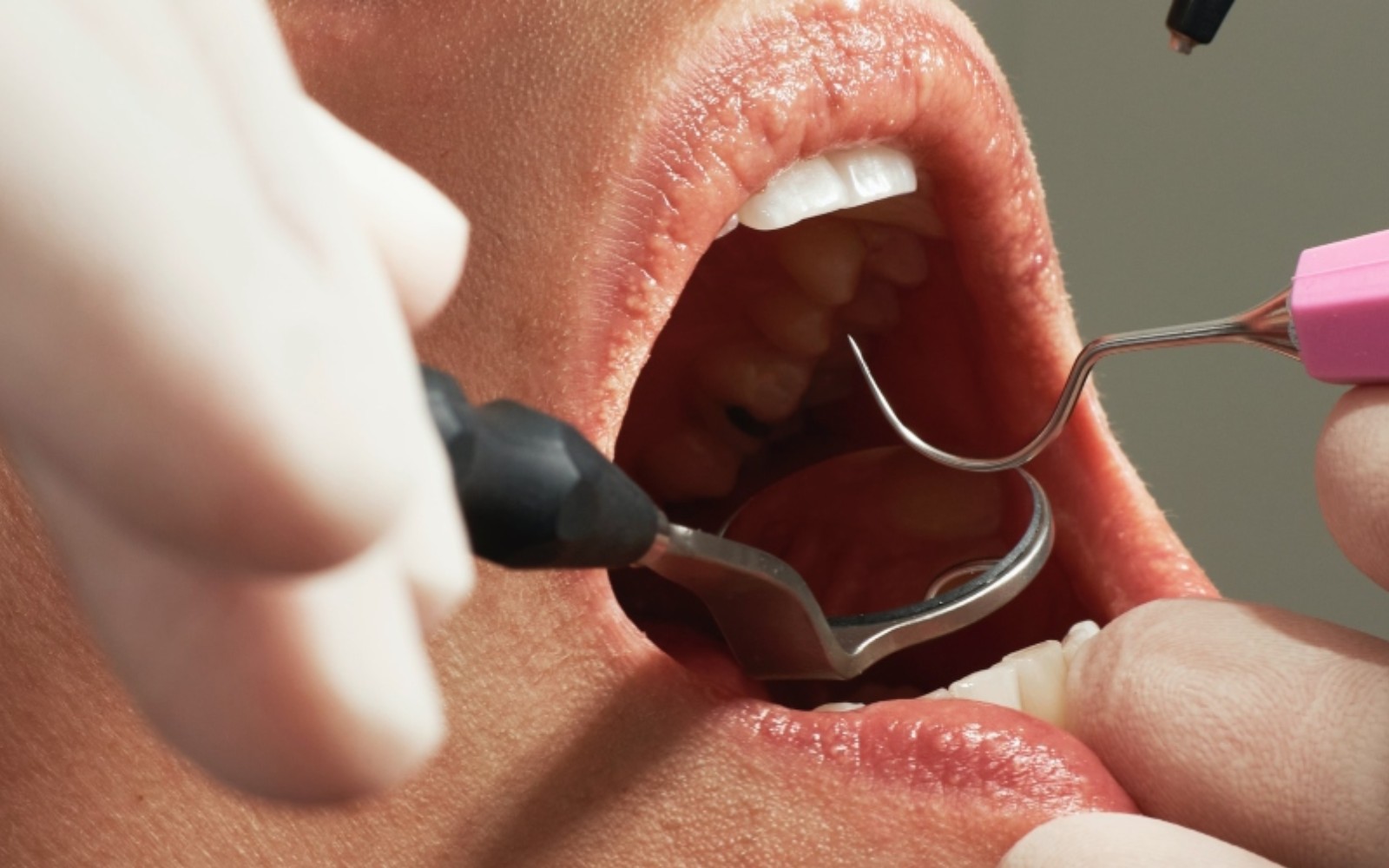 Mouth ulcers