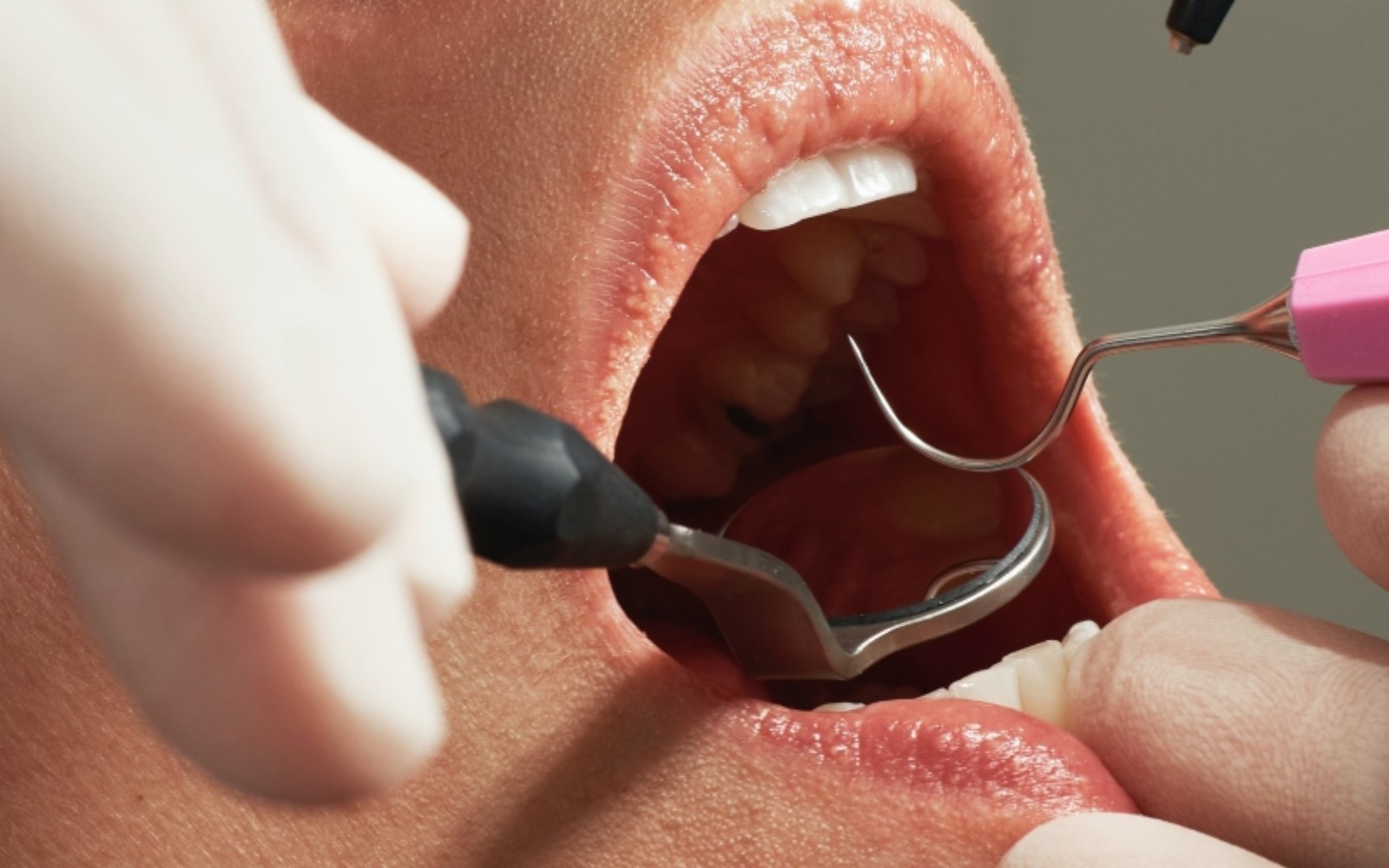Cuts in the Mouth: How to Treat and Prevent Oral Wounds