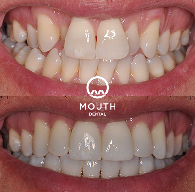 Invisalign Case