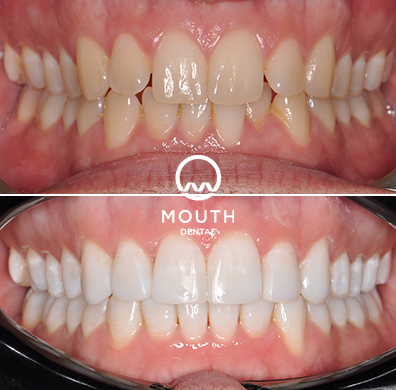 Invisalign Case