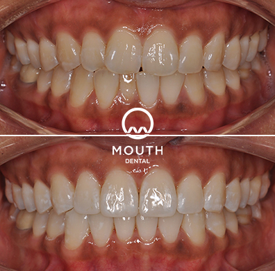 Invisalign Case