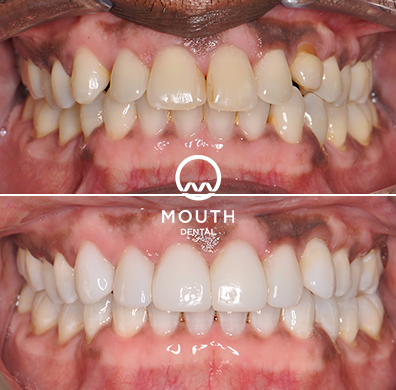 Invisalign Case