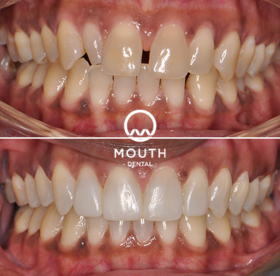 Invisalign Case