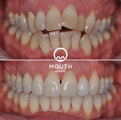 Invisalign Case