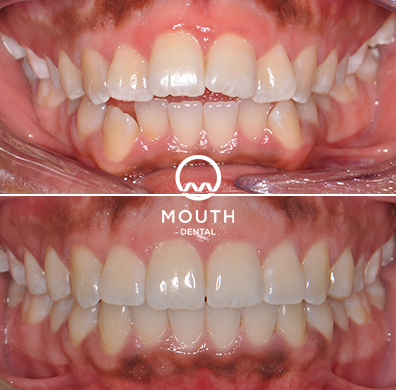 Invisalign Case