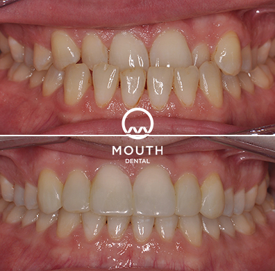 Invisalign Case