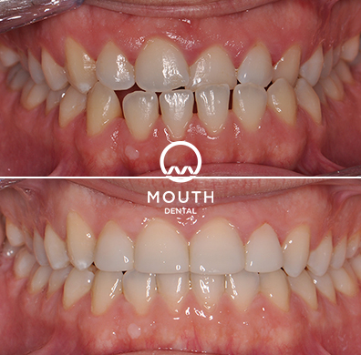 Invisalign Case