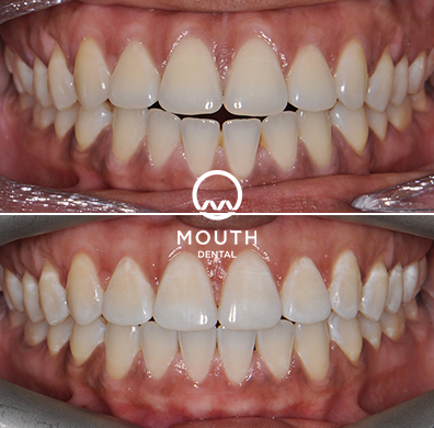 Invisalign Case