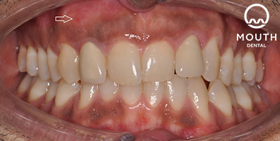 After Dental Implant