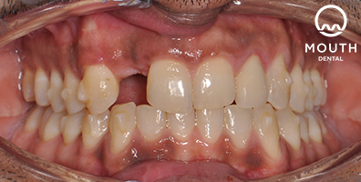Before Dental Implant