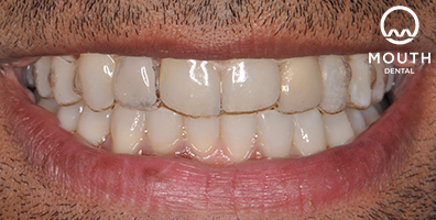 During Dental Implant