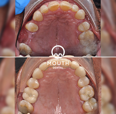 Invisalign Lite for 6 Month Case